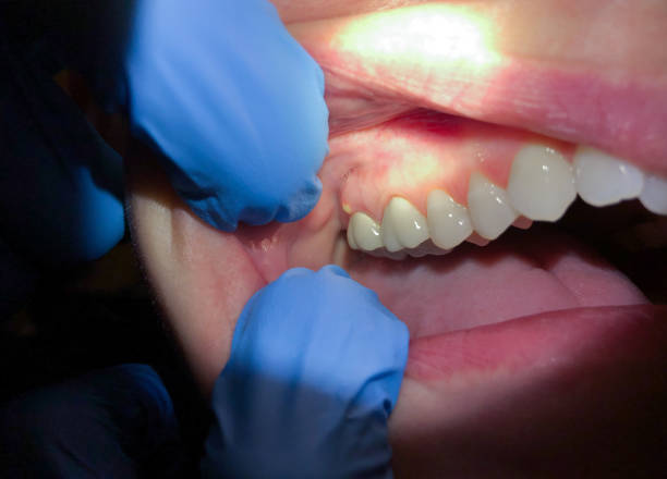 Best Emergency Broken Tooth Repair in Oak Hills, CA